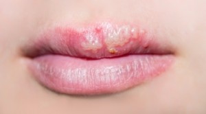 Best Way To Treat Herpes Simplex 1 : Whats Love Got To Do With How To Obtain Rid Of Fever Blisters_